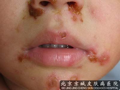 脓包疮