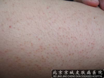 皮肤淀粉样变性治疗