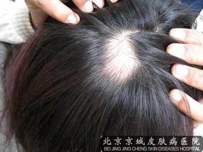 鬼剃头怎么治能 么