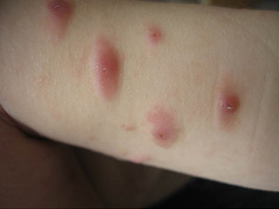 丘疹性荨麻疹怎样治呢