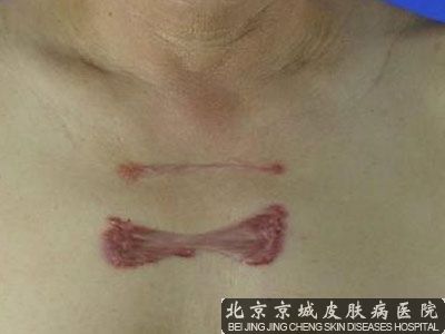 北京境内的皮肤医院不留疤