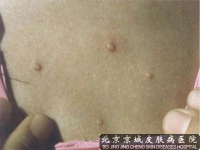 刺猴怎么治疗