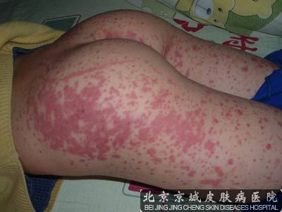 过敏性紫癜挂什么科