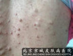 治疗多发性脂肪瘤