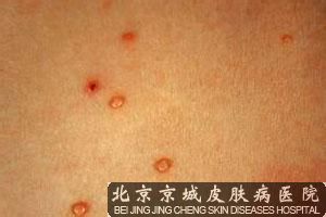 传染性软疣怎么治疗