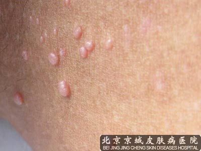 软疣怎么治疗才 