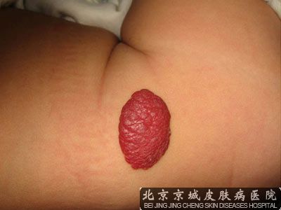 血管瘤专家
