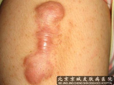 疤痕疙瘩治疗哪里好