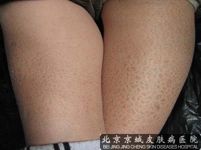 哪个医院治疗鸡皮肤