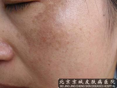 脸色暗黄色素沉淀怎么办