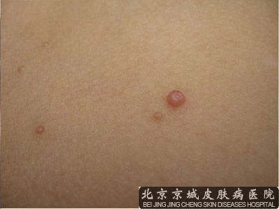 过敏性软疣怎么治疗