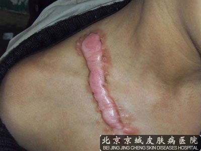 蟹足肿怎么去除