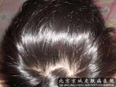 头发脱落