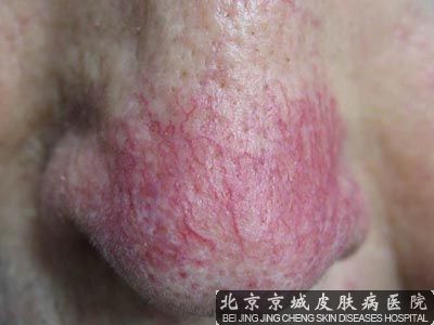 酒渣鼻治疗方法