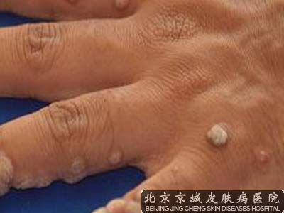 跖疣手术大概多少钱