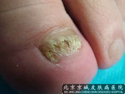 甲沟炎流脓怎么办