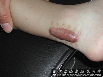 伤疤怎么减少