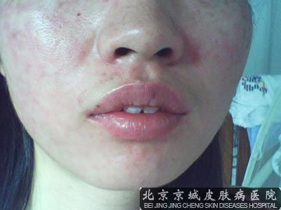 脸上严重脱皮怎么办