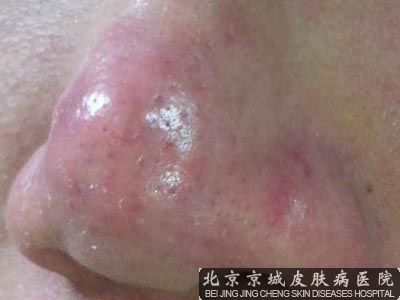 酒糟鼻怎样能 