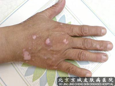 白点病的护理措施
