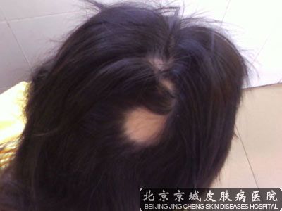 北京鬼剃头哪里治疗