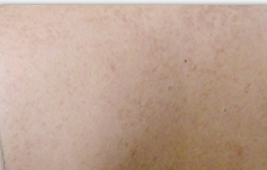 汗管瘤怎么治疗