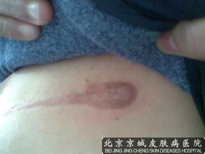 北京哪家修复手术疤痕医院好