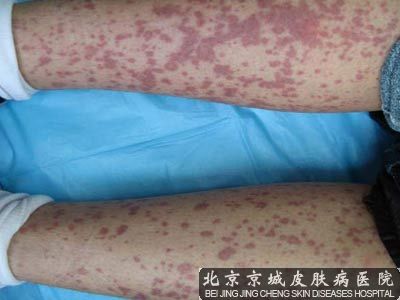 北京治的好的过敏性紫癜
