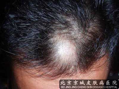 治疗鬼剃头