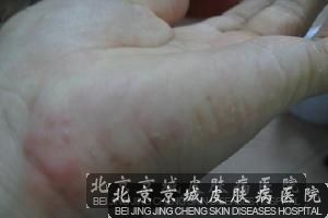 小孩手上起小水泡是怎么回事