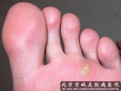 脚指上长疣子