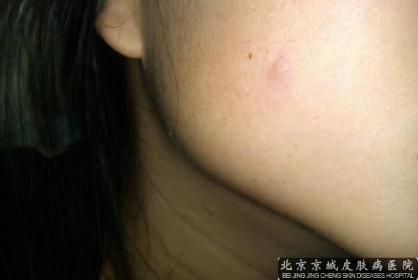 上火脸上起红疙瘩怎么办