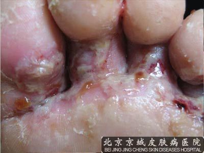 水泡型脚气怎么治