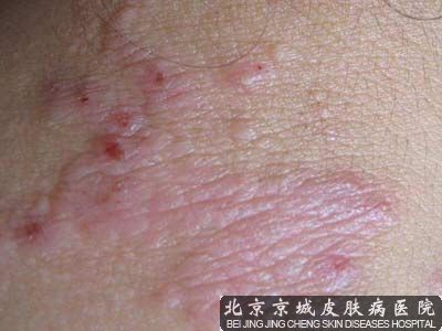 北京哪家医院治紫癜病好