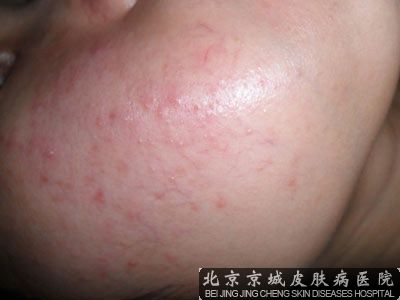 治疗皮肤淀粉样变