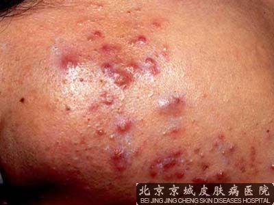 伤口愈合不留疤