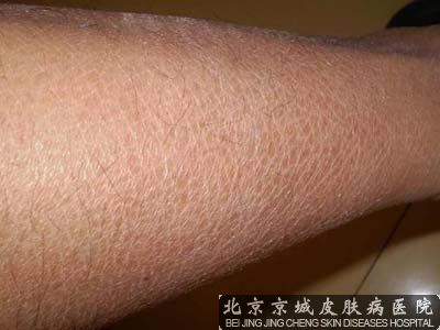 怎样治疗鸡皮肤