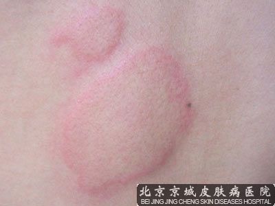 北京有治疗荨麻疹的医院