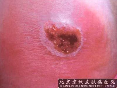 宝宝脸上长疣怎么办