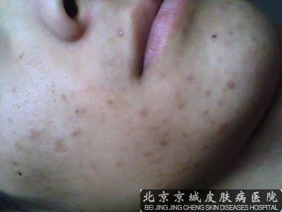 脸上点痣留疤怎么办