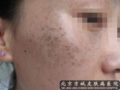 北京皮肤医院点痣较好