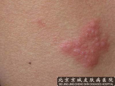 北京那里治疗蛇胆疮好