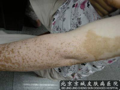 胳膊上有小白点