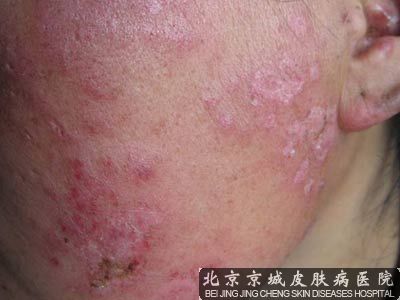 红斑狼疮盘状损害