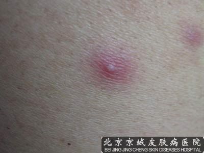 毛囊炎怎么办