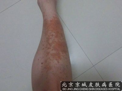 过敏性紫癜如何治疗