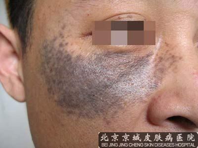 北京看伊藤痣哪家医院好