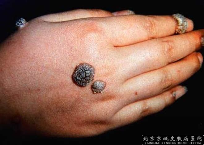 北京治疗皮肤病疣