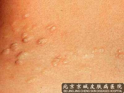 脂肪瘤的治疗方法