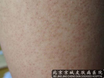 鸡皮肤怎么治疗